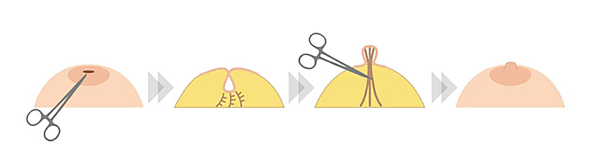 乳头内陷修复过程