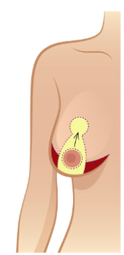 巨乳缩小切口及术式示意图