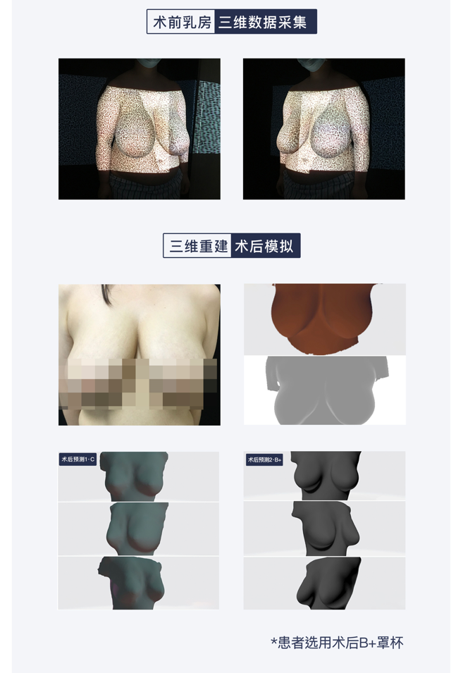 巨乳缩小术前3D预测示意图