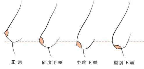 乳房下垂程度说明