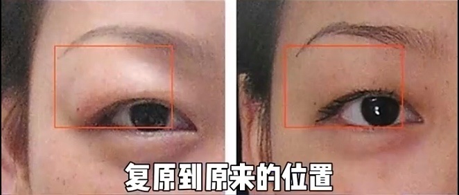 泪腺脱垂形成肿泡眼